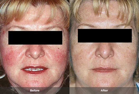 rosacea treatment #10