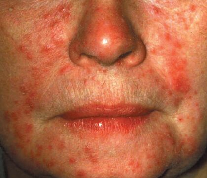 Understanding Rosacea: bumps and pimples