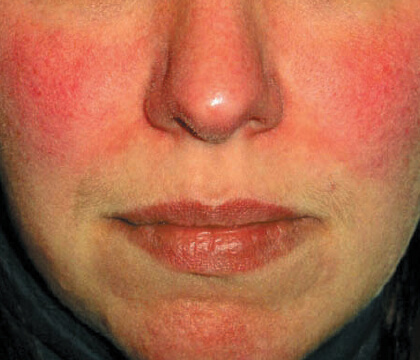 Understanding Rosacea: facial redness