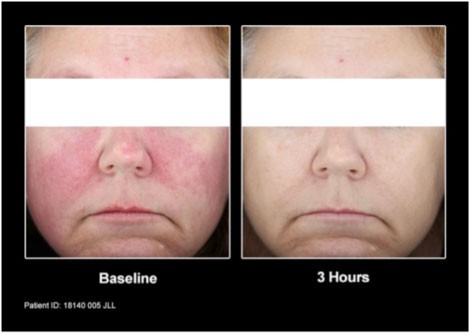 Patients from the clinical trial before and after treatment with Mirvaso Gel.