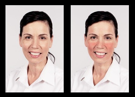 Photo of model with clear skin and simulated rosacea symptoms that was used in the general population survey.
