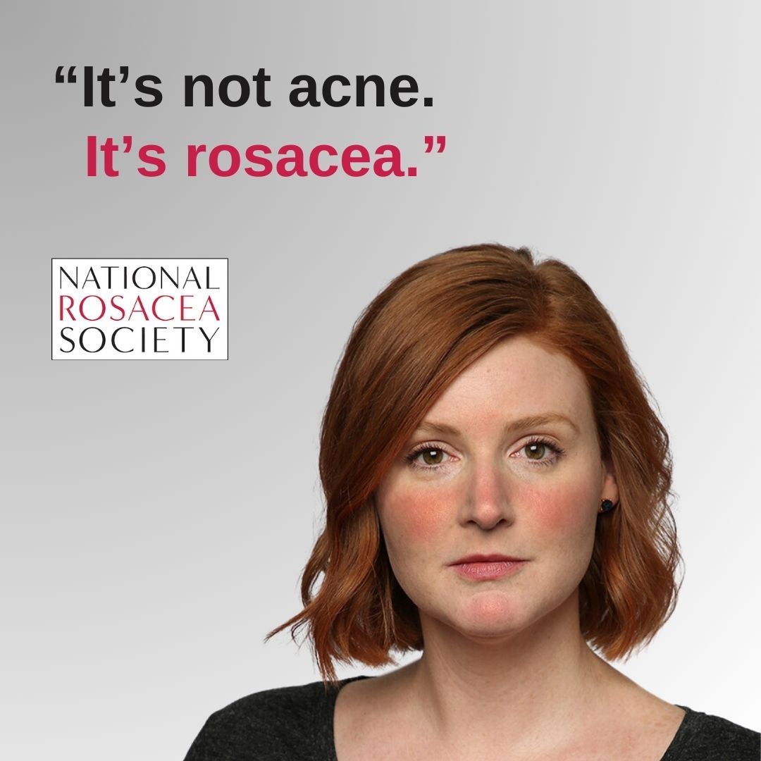 Downloadable Image of woman with rosacea saying It's not acne it's rosacea