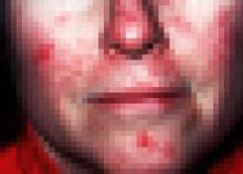pixelated face with rosacea