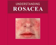 Understanding Rosacea patient booklet
