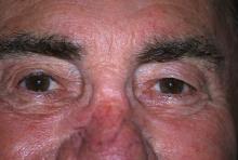 man with ocular rosacea