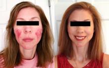 rosacea patient before and after treatment