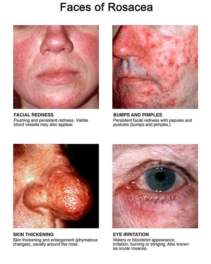 All About Rosacea Rosacea Org