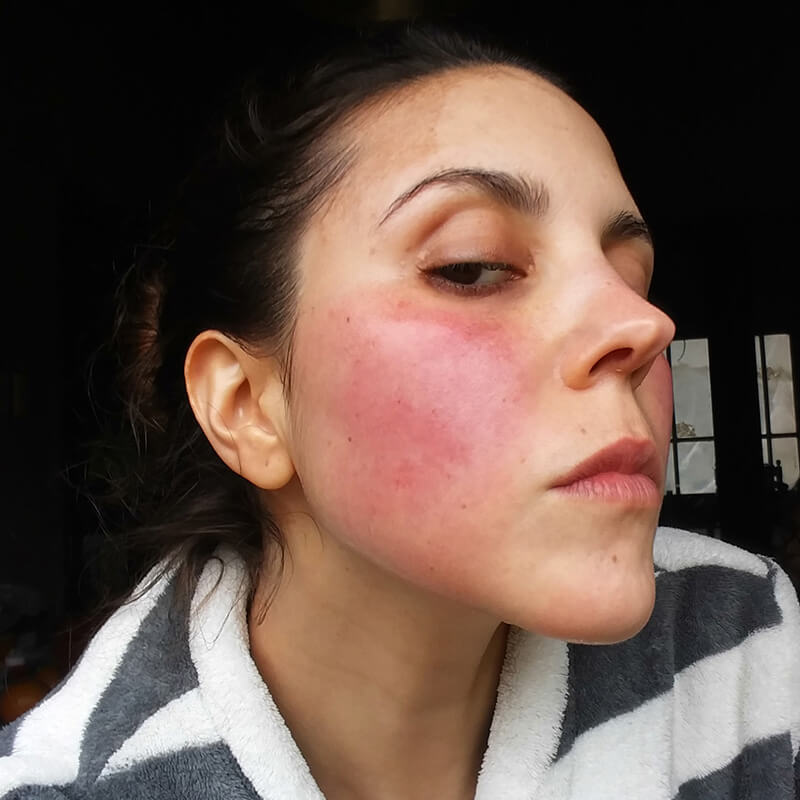 Persistent Facial Redness Is The Most Common And Bothersome Sign Of Rosacea Survey Finds