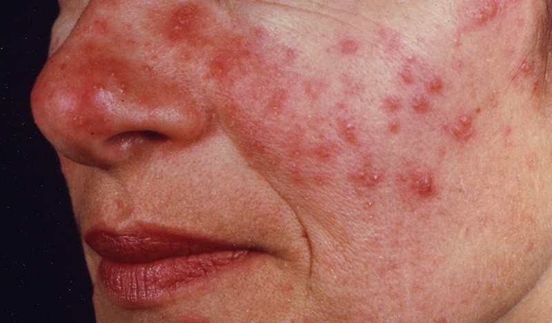 New Study Examines Differences Between Rosacea And Acne Rosacea