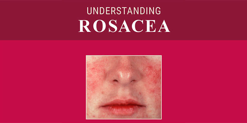 Understanding Rosacea 