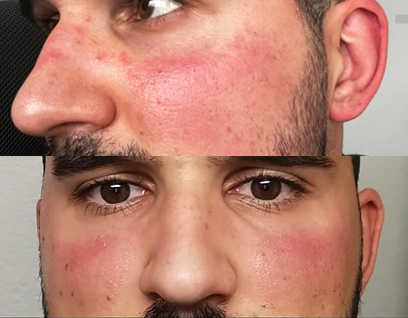 male rosacea patient with persistent erythema