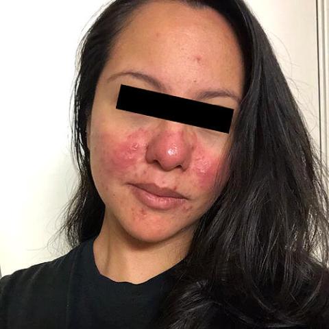 rosacea patient