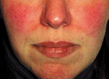 persistent facial erythema